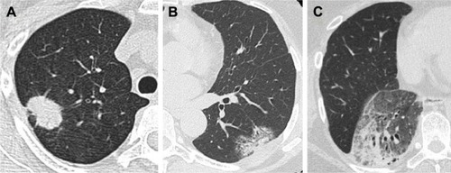 Figure 1 Computed tomography findings of lung invasive mucinous adenocarcinoma.