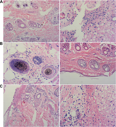 Figure 7 Observation on tissue sections of B-HA injection on wound inflammation (A) Control; (B) B-HA; (C) HA. (200×). (A) Control group: A large number of inflammatory cells infiltrated around the hair follicles and sweat glands in the dermis; a large number of inflammatory cells infiltrated in the wound margin. (B) B-HA group: There is a small amount of bleeding around the wound edge, and a small amount of inflammatory cell infiltration around the hair follicle, a very small amount of inflammatory cell infiltration between the connective tissues of the dermis. (C) HA group: No inflammatory cell infiltration around the hair follicle, red blood cells and inflammatory cells around the wound margin, but denser; the wound margin is clearly demarcated from normal tissue, and granulation tissue is formed.