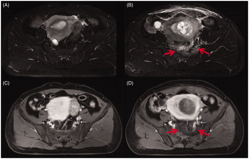 Figure 3. Transverse section through 2nd sacral vertebrae of MR images obtained from a 43-year-old patient with uterine fibroids before and 1 day after HIFU. (A) Pre-HIFU T2WI showed normal signal intensity in the sacrum and the soft tissue adjacent to the sacrum; (B) Post-HIFU T2WI showed a sheet-like hyperintense area in the sacrum and the soft tissue anterior to the sacrum (arrows); (C) Pre-HIFU contrast-enhanced image showed normal perfusion in the sacrum and the soft tissue adjacent to the sacrum; (D) Post-HIFU contrast-enhanced image showed no perfusion in the area corresponds to the signal changed area in the sacrum and the soft tissue adjacent to the sacrum on post-HIFU T2WI (arrows).