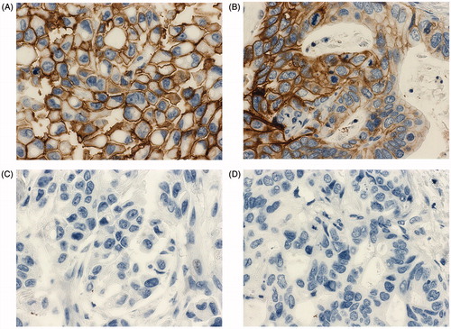 Figure 4. Immunohistochemistry staining of human invasive ductal carcinoma of the breast (A, C) and human lung adenocarcinoma (B, D) specimens for CA XII expression using the MAb 3D8 (A, B) and an irrelevant MAb 1F8 (C, D). The hibridoma supernatant was diluted 1:10. Original magnification × 400.