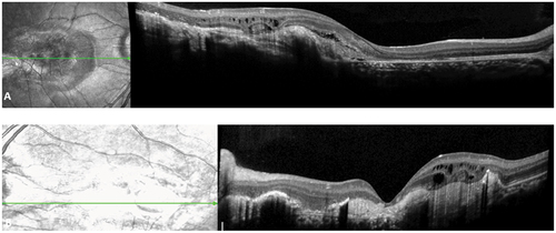 Figure 3. SD OCT (A) (B) demonstrated subretinal fibrosis, serous detachment and cystoid formations corresponding pre-epithelial choroidal neovascularization. OS (B) presence of additional macular atrophy.