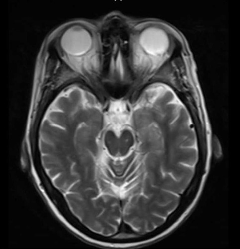 Figure 3 Admission 9 months prior showing nonspecific FLAIR abnormality in the left mesial temporal lobe.