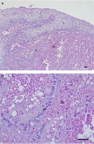 Figure 3. Histology of the resected ovarian follicle, showing: a) relatively thick theca (t), and the single cuboidal-columnar layer of follicular cells (fc) are displaced, possibly as a result of the surgery but this may be secondary to POFS; b) the follicular cells (fc) and mature yolk protein (yp) with very few vesicles present and no evidence of inflammation or degeneration (H&E, scale bars = 50 µm).