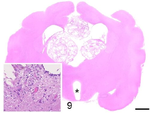 Figure 9. Case 3. A multinodular cholesterol granuloma compresses the lateral ventricles. The third ventricle is markedly dilated (asterisk). Inset: There is, hypercellularity, rarefaction and vacuolation of the neuropil (degeneration) and rare hemosiderin-laden macrophages (chronic haemorrhage). Bar = 3 mm.