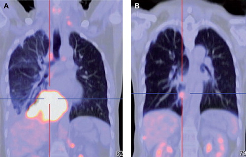 Figure 2. A. Coronal view of PET/CT at diagnosis showed a hypermetabolic mass in the right lower lobe; B. Significant improvement in the right lower lobe mass after chemotherapy.