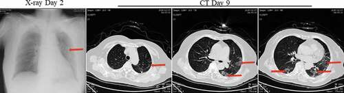 Figure 9. X-ray on day 2 and Chest CT scans on 9 after onset for Pt-7. X-ray showed high-density effusions in the middle lobe of the left lung on the second day. CT showed scattered bilateral multiple high-density effusions, faintly exudative shadows along the lungs especially in the left lung on day 9. Red arrows indicate typical lesions.