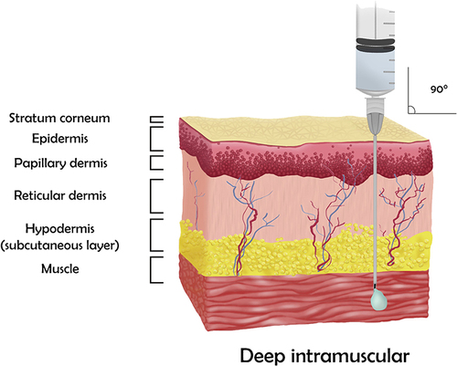 Figure 4 The deep intramuscular application technique.