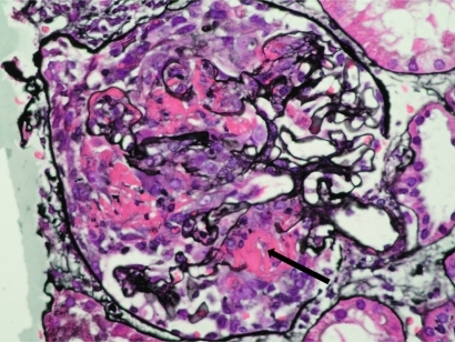 Figure 2 Renal biopsy from a patient with AAV and severe renal failure showing a glomerulus containing an extensive cellular crescent with a break in the basement membrane and surrounding fibrin deposition (arrowed) Methenamine silver stain, X400.