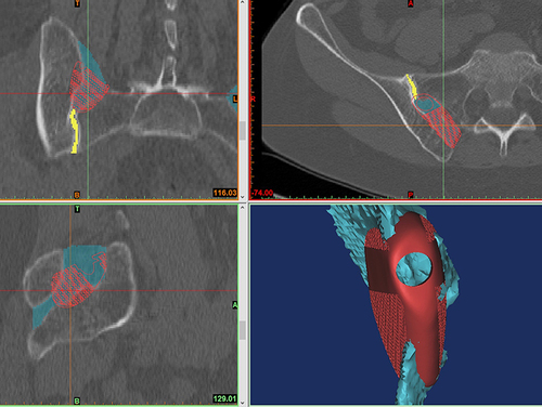 Figure 6 Three-dimensional volumes of the recess (turquoise) and SIJ (yellow) are created to derive the geometries and sizes of the individual implant bodies (red).