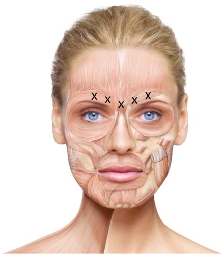 Figure 2 Injection sites for treatment of glabellar frown lines. Reproduced with permission from Merz Pharmaceuticals GmbH.