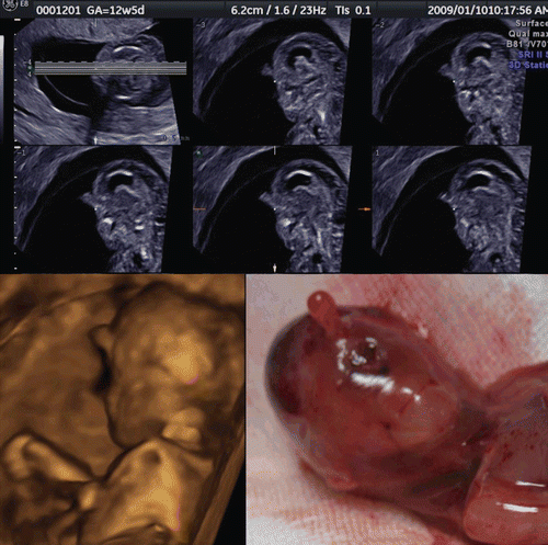 Figure 31.  Proboscis associated with holoprosencephaly at 12 weeks of gestation. Upper; Tomographic facial sagittal imaging of holoprosencephalic fetus. Lower left; 3D reconstructed image of fetal face, lateral view. Lower right; Macroscopic picture after termination of pregnancy.