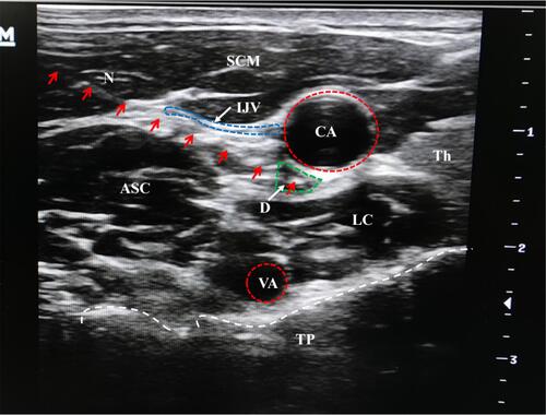 Figure 2 A schematic illustration of ultrasound-guided lidocaine injection.Notes: Red arrows: needle trajectory; white arrows: arrows for indications; red-dotted circles: the shapes of the arteries; blue-dotted circle: the wall of internal jugular vein; green-dotted circle: diffusion of local anesthetics; white-dotted line: the shape of transverse process.Abbreviations: ASC, Anterior scalene muscle; CA, Carotid artery; D, Drug; IJV, Internal jugular vein; LC, Longus colli muscle; N, puncture needle; SCM, Sternocleidomastoid muscle; TH; Thyroid gland; TP, Transverse process; VA, Vertebral artery.