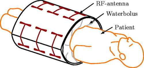 Figure 1. Schematic illustration of a typical RF hyperthermia treatment setup for the pelvic region. Note that the waterbolus aids the transmission of the electromagnetic fields into the patient, while simultaneously cooling the skin.