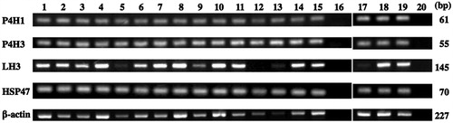 Figure 5. Reverse transcription polymerase chain reaction of collagen modifying enzymes. Positive controls for mRNAs of prolyl 4-hydroxylase 1 (P4H1), prolyl 4-hydroxylase 3 (P4H3), lysyl hydroxylase 3 (LH3), and heat shock protein 47 (HSP47) were shown in lanes 1 and 17. The mRNAs of P4H1, P4H3 and HSP47 were expressed in non-neoplastic tonsils and lymph nodes (lanes 2 and 3, respectively) and lymphomas (lane 4, small lymphocytic lymphoma; lane 5, nodal marginal zone lymphoma; lane 6, extranodal marginal zone lymphoma of mucosa-associated lymphoid tissue; lane 7, mantle cell lymphoma; lanes 8 to 10, follicular lymphoma grades 1, 2 and 3, respectively; lane 11, peripheral T-cell lymphoma; lane 12, enteropathy-associated T-cell lymphoma; lane 13, angioimmunoblastic T-cell lymphoma; lane 14, nodular sclerosis classical Hodgkin lymphoma; lane 15, mixed cellularity classical Hodgkin lymphoma; lane 18, diffuse large B-cell lymphoma not other specified, germinal center B-cell-like subgroup; lane 19, diffuse large B-cell lymphoma not other specified, non-germinal center B-cell-like subgroup), while LH3 mRNA was expressed in most cases, except for enteropathy-associated T-cell lymphoma. Lanes 16 and 20, negative control.