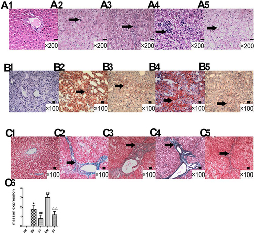 Figure 3 Pathological changes in the liver of diabetic rats before and after L6H4 treatment upon HE (A1–A5 Scale bar: 50 μm), Red Oil O (B1–B5 Scale bar: 100 μm) and Masson (C1–C5 Scale bar: 100 μm) staining and grading (C6). HE staining showed inflammation in the liver of the HF and DM group (Black arrow in A2 and A4), which was reduced in rats treated with L6H4 (A3 and A5). Red Oil O staining showed the diffuse distribution of adipose droplets (Black arrow in B2 and B4), which was reduced in rats treated with L6H4 (B3 and B5). Masson staining indicated hyperplasia of the collagen fibers (Black arrow in C2 and C4), which was diminished in rats treated with L6H4 (C3 and C5). Mean ± SD; *P<0.05 vs NC, **P<0.05 vs NC; ##P<0.05 vs HF; ΔΔP<0.05 vs DM.