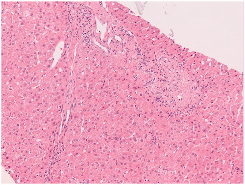 Figure 4. Microscopic examination of a liver biopsy with phlebosclerosis. Histopathology of a liver biopsy with phlebosclerosis characterized by sclerosis of the portal tract with diminished caliber of the portal vein caliber and extraportal shunt vessels in a patient with inflammatory bowel disease treated with thioguanine (Hematoxylin-Eosin stained).