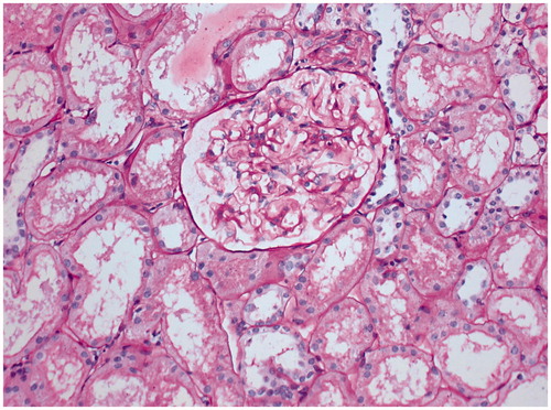 Figure 3. Representative protocol biopsy of 59-years-old renal allograft recipient from group-1, who underwent transplantation with his sister’s kidney (HLA match – 1/6) on 31 October 2007. He is on maintenance immunosuppression of prednisone, 5 mg/d since 4 years. Periodic Schiff stain, ×200.