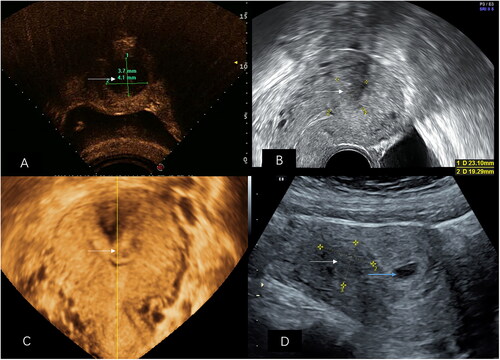 Figure 1. A 33-year-old woman, with a history of miscarriage, achieved a successful full-term delivery via cesarean section after USgHIFU treatment for type 2 submucous leiomyoma. The maximum diameter was 4.2 cm, with an effective volume in the uterus cavity of 6.1 cm3 and a volume of submucous leiomyoma of 27.2 cm3. The contrast-enhanced ultrasound revealed no perfusion of uterine lesion immediately after the surgery (arrow pointing in Figure A). One year after USgHIFU treatment, both the effective volume in the uterine cavity and the volume of submucous leiomyoma shrank obviously (arrow pointing in Figure B in the sagittal plane and Figure C in the coronal plane). The maximum diameter was 2.4 cm, with an effective volume in the uterus cavity of 3.0 cm3 and a volume of submucous leiomyoma of 6.0 cm3. After 16 months, pregnancy was achieved. Gestational sac (blue arrow pointing in Figure D) was seen along with the reduced residual submucous leiomyoma, with a maximum diameter of 2.2 cm (white arrow pointing in Figure D). USgHIFU, ultrasound-guided high-intensity focused ultrasound.