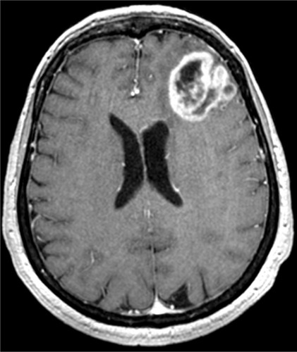 Figure 1 T1-weighted contrast enhancement magnetic resonance imaging scan of Case 1.