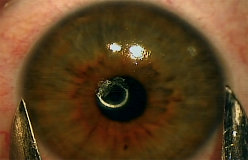 Figure 2 Precision white-to-white measurement with manual calipers performed with patient supine under an operating microscope with topical anesthesia and lid speculum measuring mid-gray zone with high magnification. Courtesy of Vance Thompson.