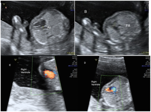 Figure 1. Female fetus. A: left ventricle outflow, aorta (Ao); B: right ventricle outflow, pulmonary artery (PA); C: Color Doppler of right ventricle; D: right ventricle filling, but not the left.