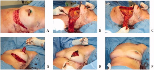 Figure 2. Surgical technique (A) Deepithelialization of the skin (B) Elevation of the subcutaneous adipose flap, saving the perforator (C) Subdermal preparation of the epigastric area (D) Tunneling of the flap (E) Fixation of the flap (F) Refixation of the IMF.