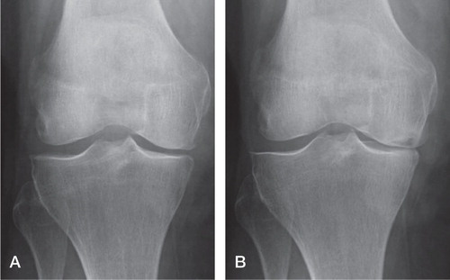 Figure 3. A. A 83-year-old woman at symptom start. Bisphosphonate treatment was initiated within 3 months after symptom debut. B. The patient used the drug for three months but had unwanted side effects and stopped the medication. The pain persisted and osteoarthritis gradually developed (Ahlbäck 4) and 2 years later, the patient had a joint replacement.