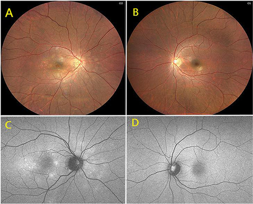 Figure 1 CFP showing multifocal small white spots surrounding the posterior pole and optic disc with the granular appearance of the fovea in the right eye (A) and the normal left eye (B). FAF showing hyperfluorescence spots in the right eye (C) and the normal left eye (D).