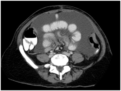 Figure 2. CT slice showing mesentery drawn together by tumour (clumped bowel).