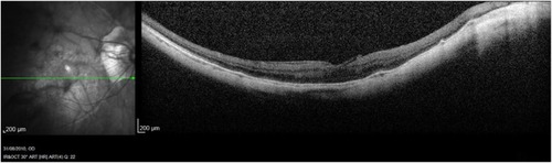 Figure 2 Optical coherence tomography of JW’s right eye, 2010.