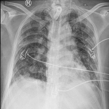 Figure 6 Chest X-ray at discharge.