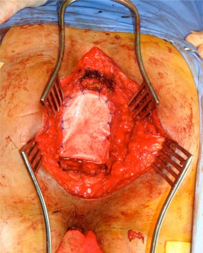 Figure 3 Perineal reconstruction with porcine dermal mesh (Permacol™; Covidien, New Haven, CT, USA) following extralevator abdominoperineal excision for low rectal cancer.