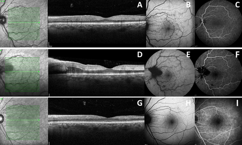 Figure 1 Case Report 1: At presentation: (A) Macular SD-OCT showing a parafoveal hyper-reflective band at the level of inner nuclear layer; (B) FAF showing venous engorgement and a fern-like pattern; (C) AF and ICGA without ischemic areas (time: 1.47.76). At 4th day of symptoms: (D) Macular SD-OCT showing a peripapillary edema and parafoveal subretinal fluid; (E) FAF showing a fern-like pattern at presentation; (F) AF and ICGA with non-perfused areas (time: 2.04.66). At 4th month of symptoms: (G) Macular SD-OCT showing a macular disorganization; (H) FAF with regression of the fern-like pattern; (I) AF and ICGA without ischemic areas (time: 1.52.66).