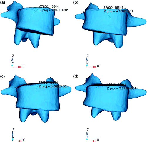 Figure 5. Measurement of the L2 vertebral rotation correction angle. (a) The correct angle of the apical vertebrae was 20.46° after rotating the rod in A2. (b) The final angle after compression was 41.68° for A2. (c) The correct angle of the apical vertebrae was 30.19° after rotating the rod in B1. (d) The final angle after compression was 37.79° for B1.