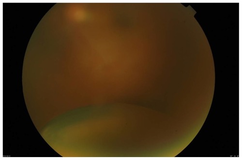 Figure 4 Preoperative ocular fundus examination of the left eye. The lens has been displaced into the vitreous cavity.