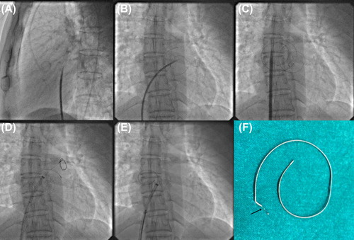 Figure 1. Transseptal puncture using Brokenbrough needle and Mullin's dilator (A). Broken 0.025 inch coiled tip guidewire in left atrium (B). Septal dilation with 14F septal dilator after introduction of another 0.025 inch coiled tip guidewire through 8F Mullin's dilator (C). Introduction of gooseneck snare in left atrium through 10F Amplatzer long delivery sheath to capture broken guidewire (D) and pulling it into sheath (E). Severed proximal end of broken guidewire after successful retrieval (arrow, F).