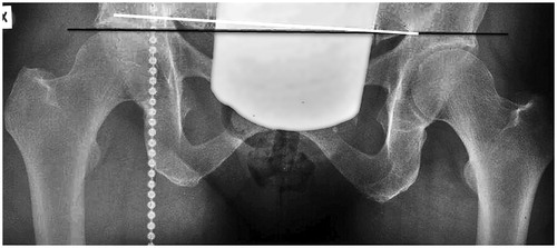 Figure 1. Woman aged 50 years. Standing radiograph with a vertical plumb line shows a 10 mm LLI (black line) and a slight pelvic tilt to the left (white line). A hip arthroplasty was performed on the longer leg 27 years later.