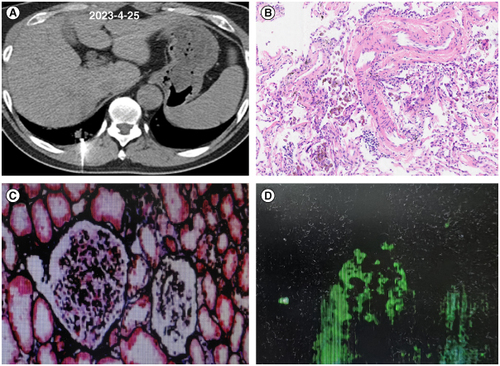 Figure 2. Tissue pathology images of lung biopsy and kidney biopsy. (A) CT images during lung puncture biopsy. (B) Pathological image of hematoxylin-eosin staining in lung tissue. (C) Images of renal tissue stained with periodic acid-silver methe-namine-masson staining. (D) Immunofluorescence detection of IgA in renal tissue.CT: Computed tomography.