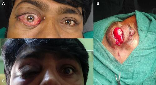 Figure 1 Clinical photograph. (A) Preoperative photograph showing proptosis of right eye. (B) Intraoperative photograph of right transcutaneous transeptal superior anterior orbitotomy and excisional biopsy. (C) One month postoperative photograph of right eye.
