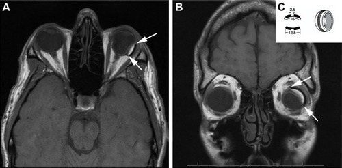 Figure 2 MRI of the orbits and brain.