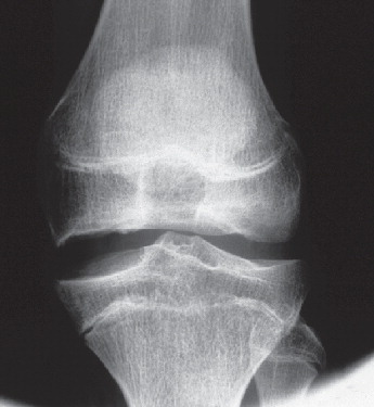 Figure 3.  Subject IV:2. Left knee at age 15. The femoral epiphyses are flattened, especially the medial one.
