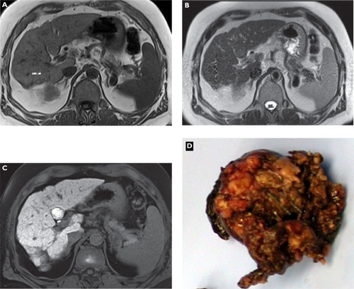 Figure 3 Well-differentiated hepatocellular carcinoma (HCC). Plain T1-weighted spoiled 2D gradient echo (GRE) A) T2-weighted half-Fourier acquisition single-shot turbo spin-echo (HASTE) B) hepatocellular phase gadoxetic acid-enhanced fat-suppressed (FS) T1-weighted spoiled 3D GRE C) and gross pathology D) in the axial plane. A small liver mass in S4b is faintly visible on unenhanced sequences showing characteristics of a HCC nodule such as a rim on T1-weighted magnetic resonance imaging (MRI) (A). Gadoxetic acid-enhanced MRI shows an enhancing lesion mimicking a benign lesion based on uptake into the well-differentiated HCC confirmed at surgery. Gross pathology is courtesy of Prof Thomas Rüdiger.