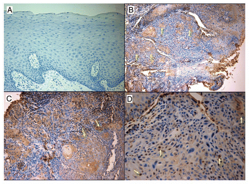 Figure 4 CIP2A expression by immunohistochemistry of oral squamous cell carcinoma. Photomicrograph part for oral squamous cell carcinoma: Figure A. Control specimen representing oral hyperkeratosis sample demonstrating total lack of any CIP2A expression (magnification x20) Figure B. Strong scattered reactivity for CIP2A noted in groups of malignant epithelial cells (yellow arrows). Some stain is also picked up by keratin pearls and the squamous eddies often seen in carcinoma biopsies (magnification ×10) Figure C. A second sample of well differentiated squamous cell carcinoma displaying numerous clusters of CIP2A positive cells. Some of the lymphocytic infiltrate also demonstrates staining (magnification ×20) (yellow arrows) Figure D. Another carcinoma sample exhibiting single malignant cells and occasional groups staining positively with CIP2A (magnification ×40) (yellow arrows). Again the staining appears localized more to the nuclei and fainter in the cytoplasm.