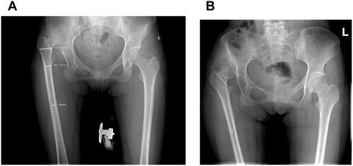 Figure 1 (A) A unilateral Crowe type IV DDH (right side) with no false acetabulum on AP radiograph (type IVA). (B) A unilateral Crowe type IV DDH (right side) with a false acetabulum on AP radiograph (type IVB).Abbreviation: CLT, the center of the lesser trochanter.