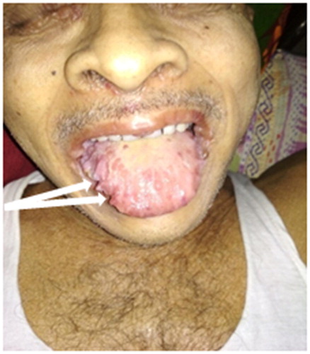 Figure 1. Lateral scalloping with macroglossia.