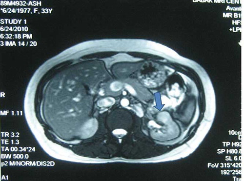 Figure 1. Magnetic resonance imaging (MRI, T2) of abdomen and pelvis in a coronal section confirmed the presence of renal mass at the middle zone of the left kidney.