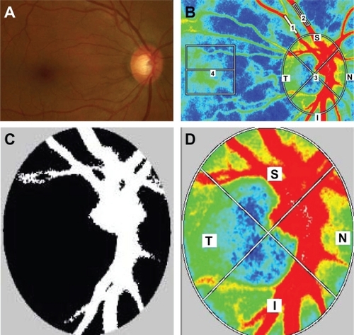 Figure 1 Representative photographs of a glaucoma patient in this study. (A) Photograph of the fundus. (B) A representative color map produced using LSFG (1, retinal artery; 2, retinal vein; 3, optic disk; 4, choroid). (C) Representative binary format images for segmentation between the vessel (white area) and tissue (black area), obtained using image viewer software with an automated definitive threshold. (D) Orientation of the quadrant assessment for the MBR in the optic disk.