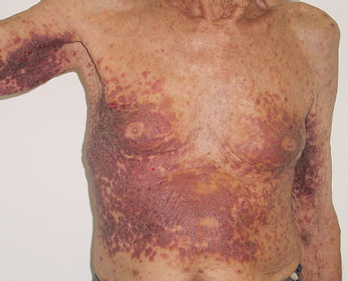 Figure 1. Purpuric plaques and papules in trunk and arms.