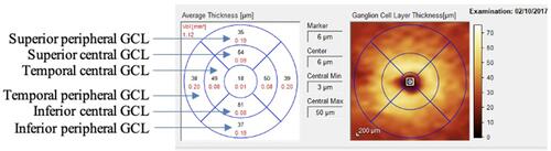 Figure 2 GCL thickness analysis by quadrants and with a central and peripheral segmentation circle with the spectralis OCT.