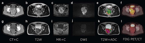 Figure 1. Morphological and functional images acquired prior to treatment (upper row) and after onset of neoadjuvant tyrosine kinase inhibitor treatment (bottom row) in a 59-year-old GIST patient. Contrast-enhanced CT (a and g), T2-weighted MRI (b and h), contrast-enhanced MRI (c and i), DW MRI (d and j), fusion of apparent diffusion coefficient (ADC) maps (obtained from DW MRI) and T2 weighted MRI (e and k) and 18F-FDG PET (f and l).